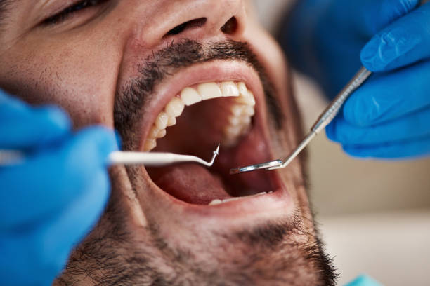 Best Emergency Dental Filling Replacement  in Cottonport, LA
